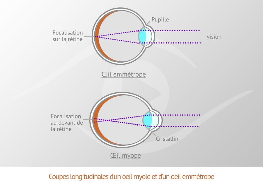 Coupe longitudinale d'un oeil myope et d'un un oeil emmétrope Coupe longitudinale d'un oeil myope et d'un un oeil emmétrope