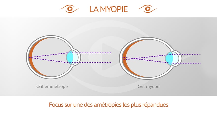 Comparaison d'un oeil myope avec un oeil emmétrope Comparaison d'un oeil myope avec un oeil emmétrope