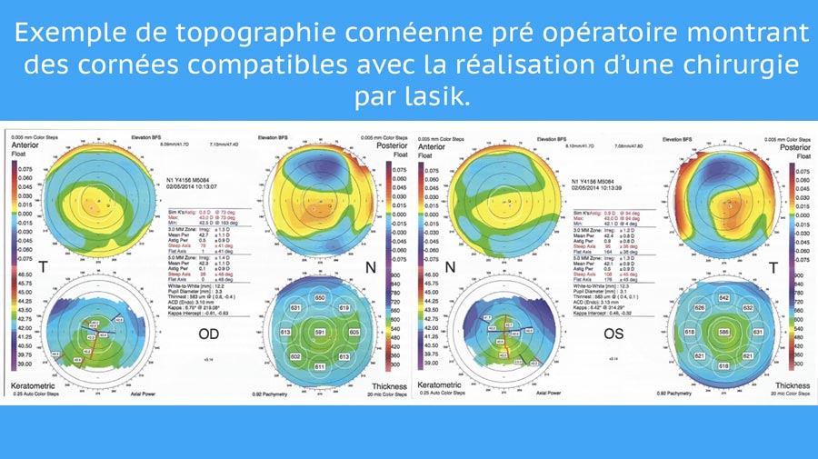 topographie cornéenne préopératoire montrant des cornées apte à subir de la chirurgie refractive. topographie cornéenne préopératoire montrant des cornées apte à subir de la chirurgie refractive.