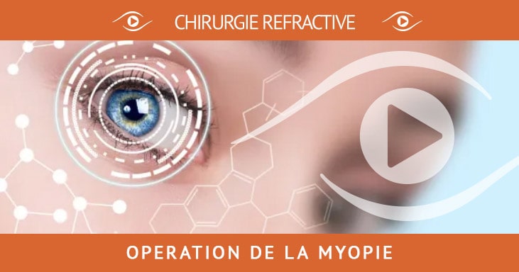 Myopie et chirurgie refractive Myopie et chirurgie refractive